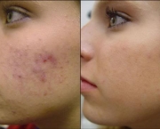 comprimidos-para-acne-10