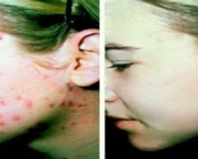 comprimidos-para-acne-11