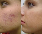 tratamento-facial-para-pele-com-acne-1