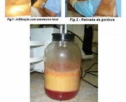 tudo-sobre-lipoaspiracao-21